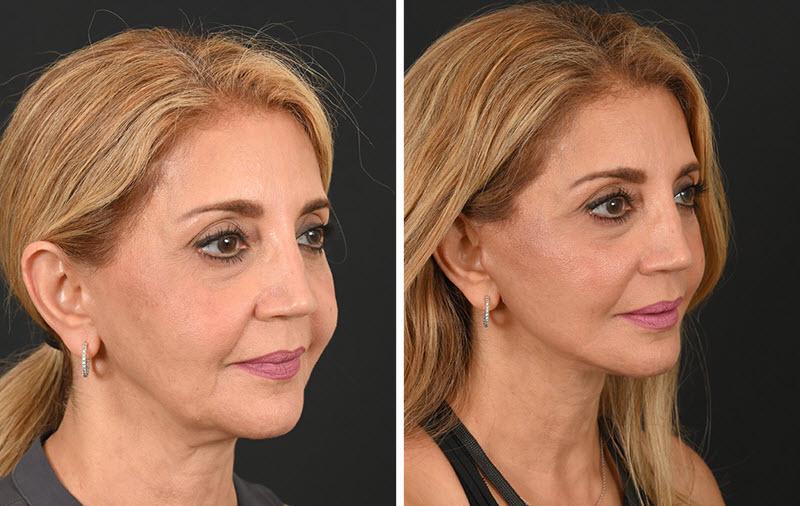 Best Facelift Surgery in India