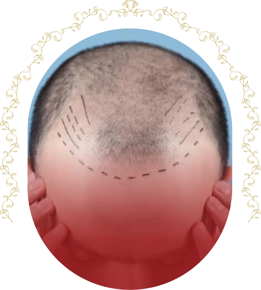 hair transplant in Jaipur 