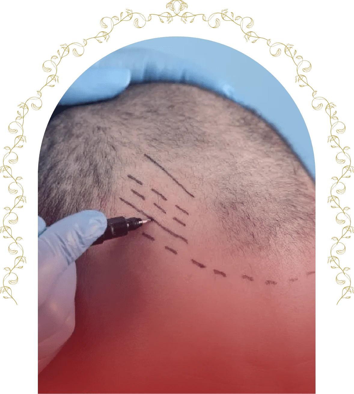 Best Hair Transplantation Doctor In Jaipur, India 	